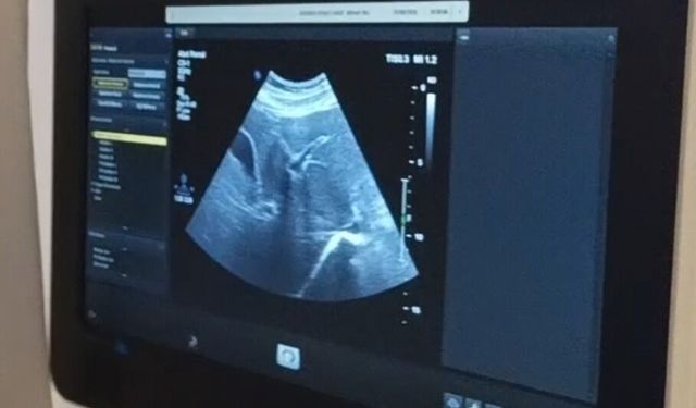 Şanlıurfa’da Karaciğer Biyopsisi Hizmeti Siverek’te Başladı